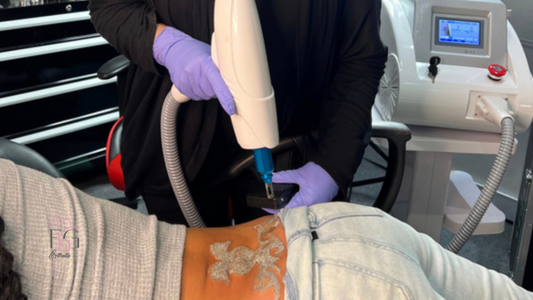 Remoción de Tatuajes